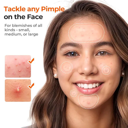 Hydrocolloid Pimple Patches Bulk (609 Count) - Anti-Acne Treatment