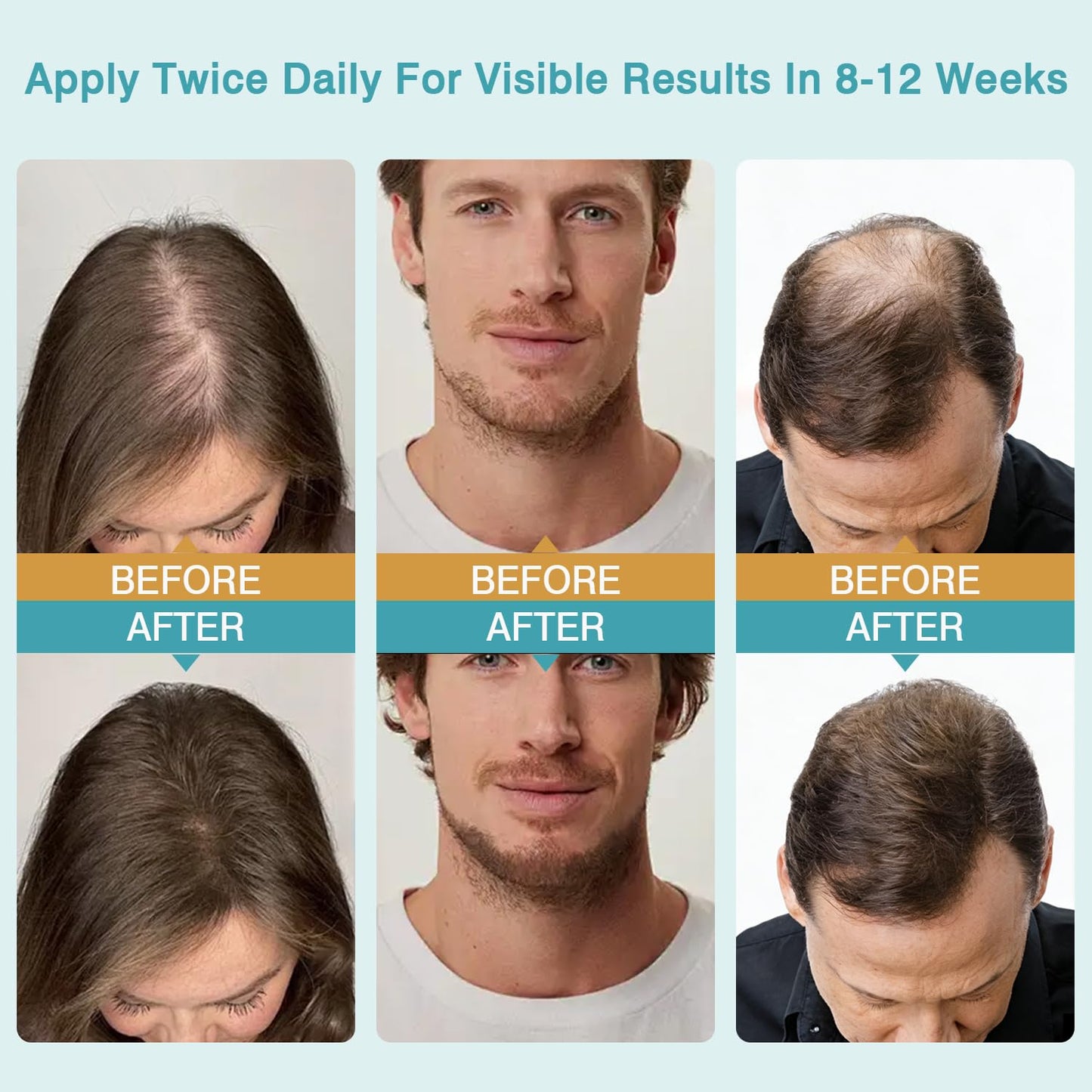 5% Minoxidil Scalp Moisturizer, Minoxidil Scalp Massage Cream for Hair Growth with Peptide