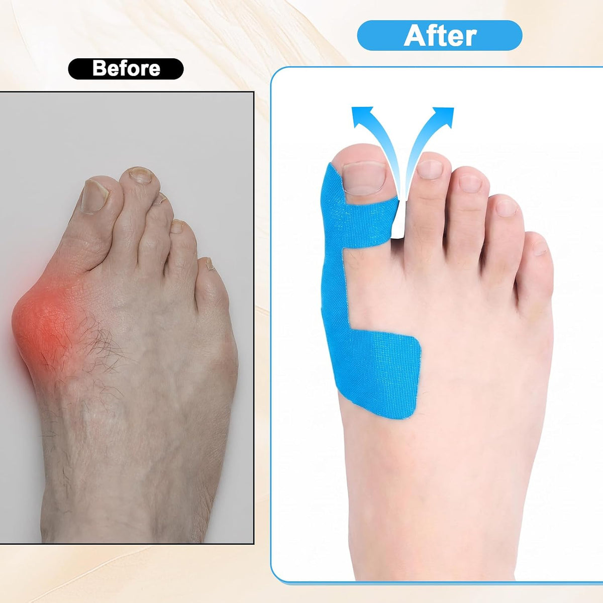 20Pcs Pre-Cut Bunion Support Tape, Elastic Breathable Latex-Free Kinesiology Tape