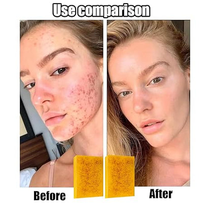 2Pcs Kojic Acid & Turmeric Soap — Turmeric Cleansing Soap for Face & Body