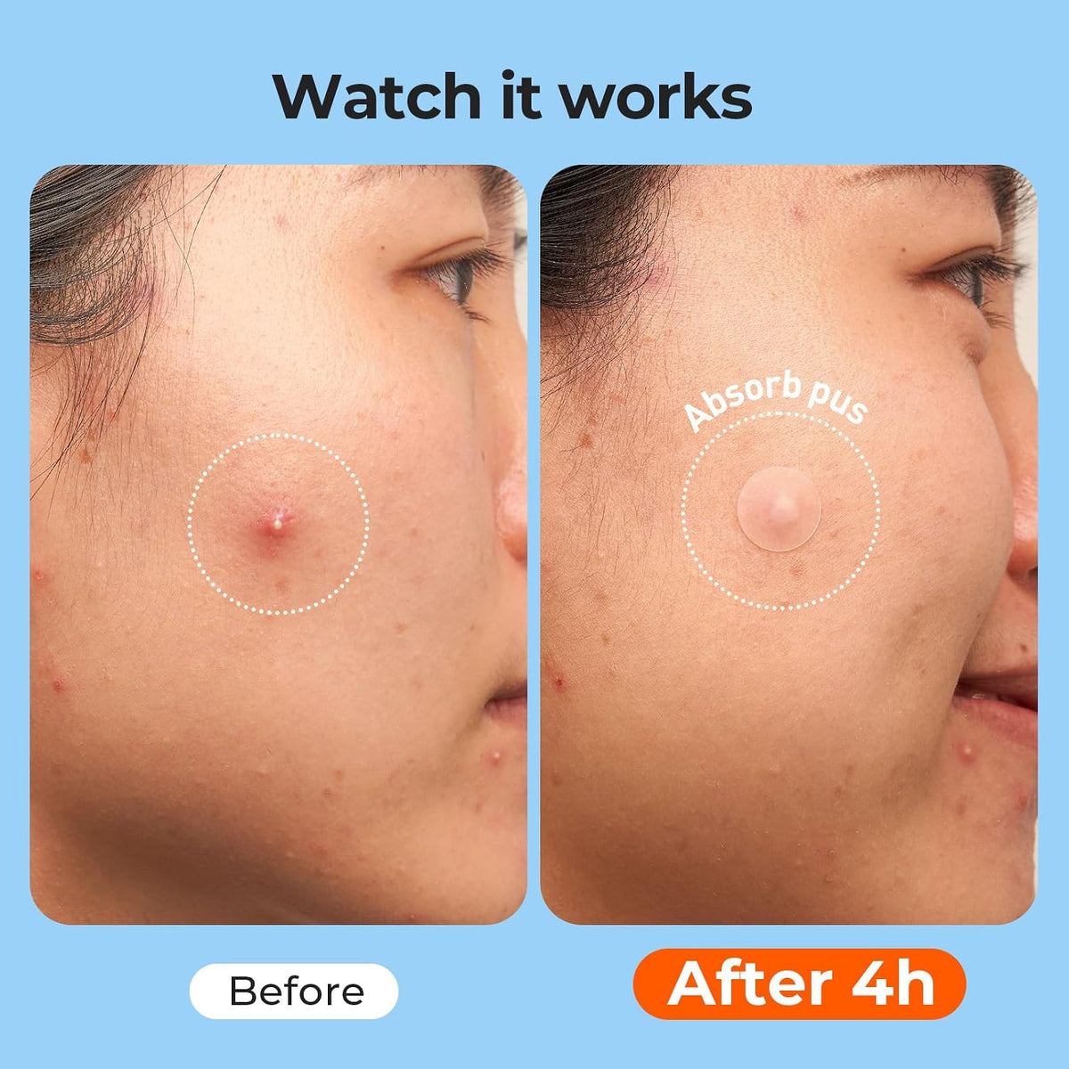 Hydrocolloid Pimple Patches Bulk (609 Count) - Anti-Acne Treatment